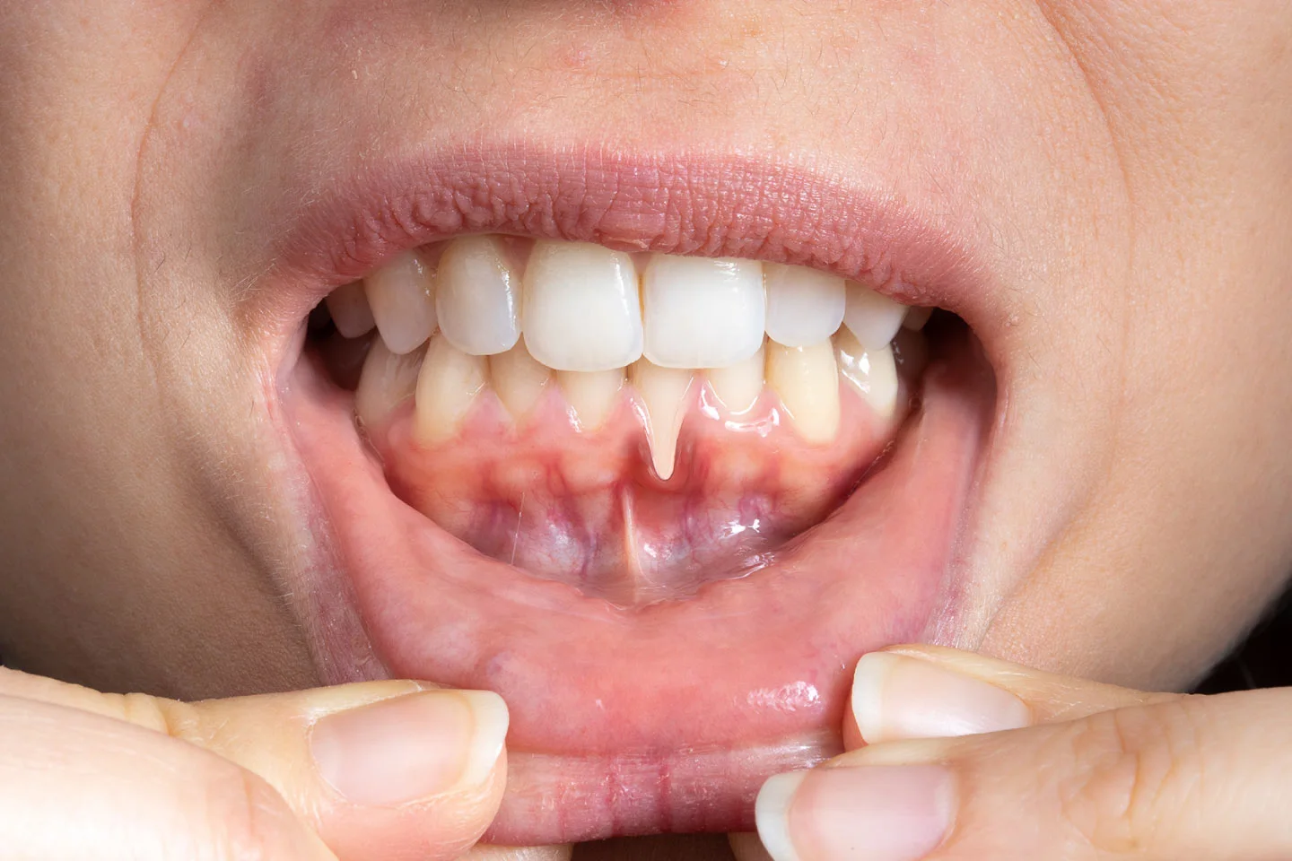 Gum Disease Defense: Strategies for Prevention and Treatment