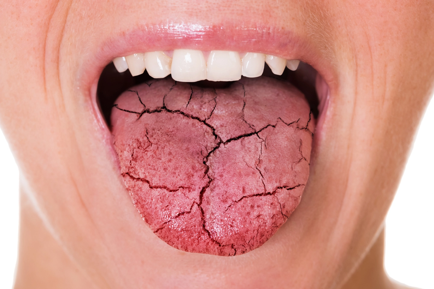 Managing Dry Mouth: Causes, Symptoms, and Treatment Options
