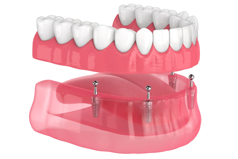 Dental implants and dentures at  Star Dental in Chicopee, MA