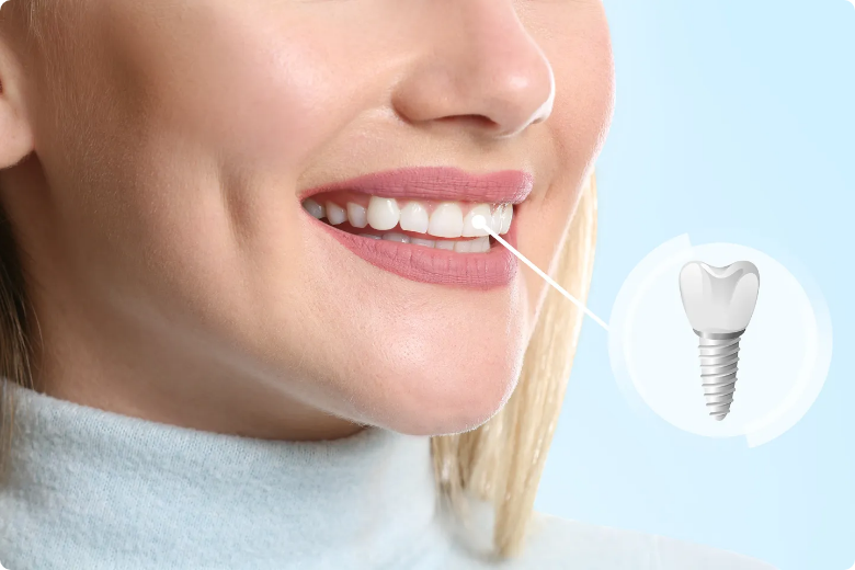 Benefits of Dental Implants
