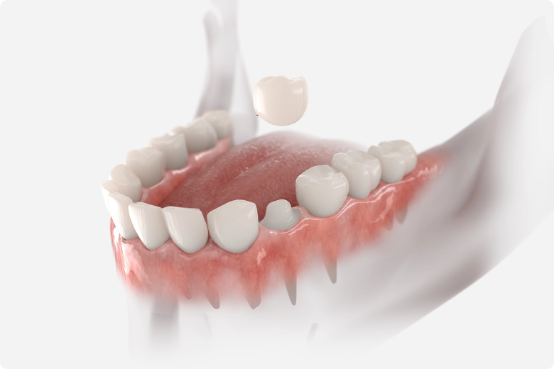 Dental Crowns Treatment Services in Colorado Springs, CO