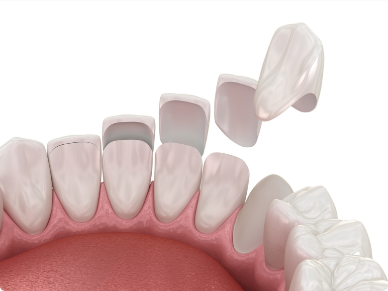 Your Complete Guide to Dental Crowns: Benefits and Options