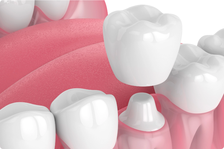 Dental Crowns for Cracked, Weak, or Worn Teeth